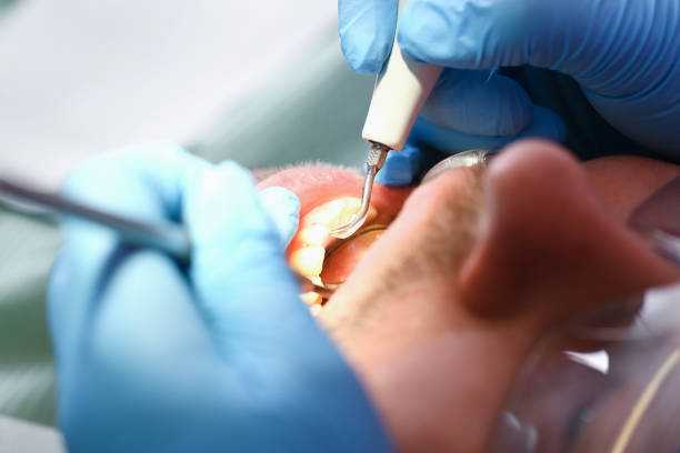 Emergency Dental Filling Replacement in AZ
